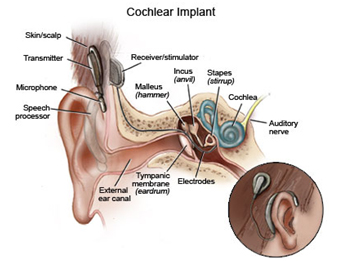 Cochlear Implant Surgery, Cochlear Implant, Health, Bionic Ear, Electronic Device